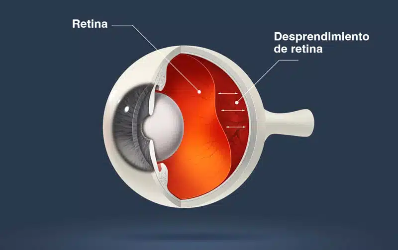 despredimeinto-retina-2-3735834